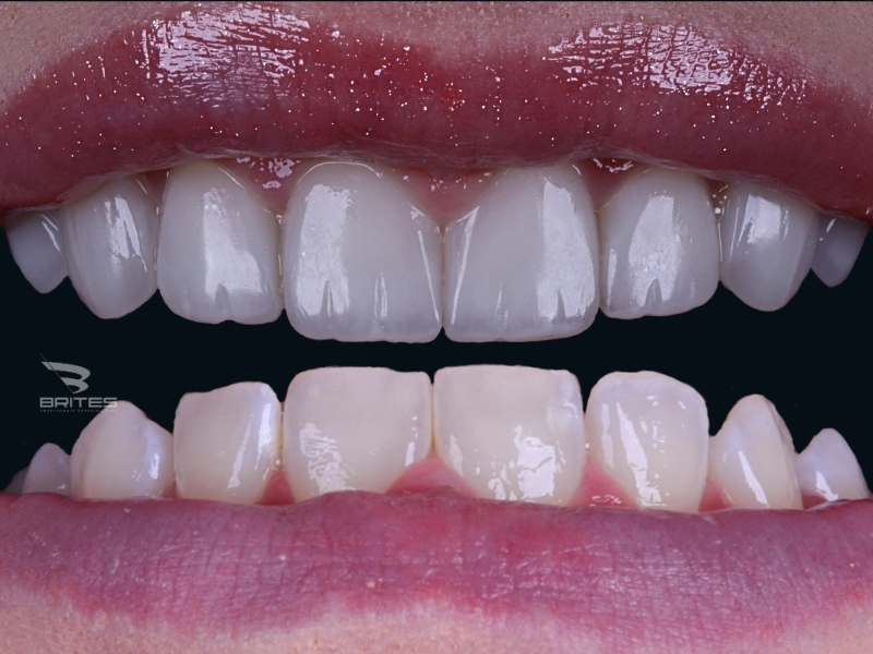 clinica brites - Carol - antes e depois