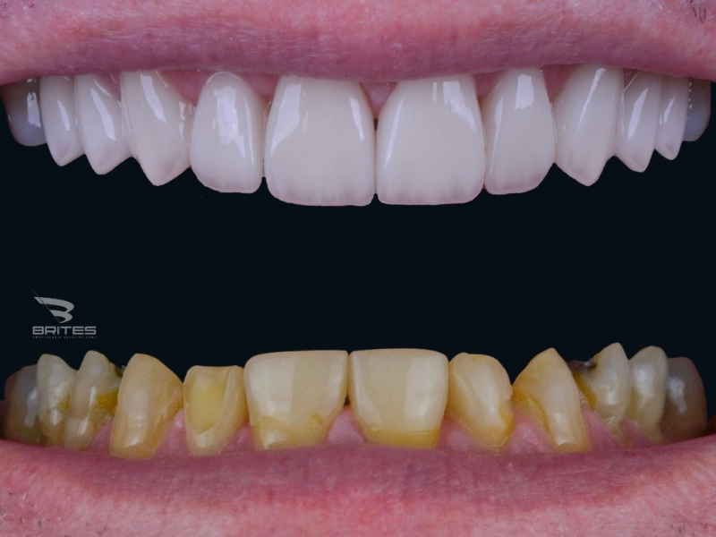 clinica brites - Leandro - antes e depois