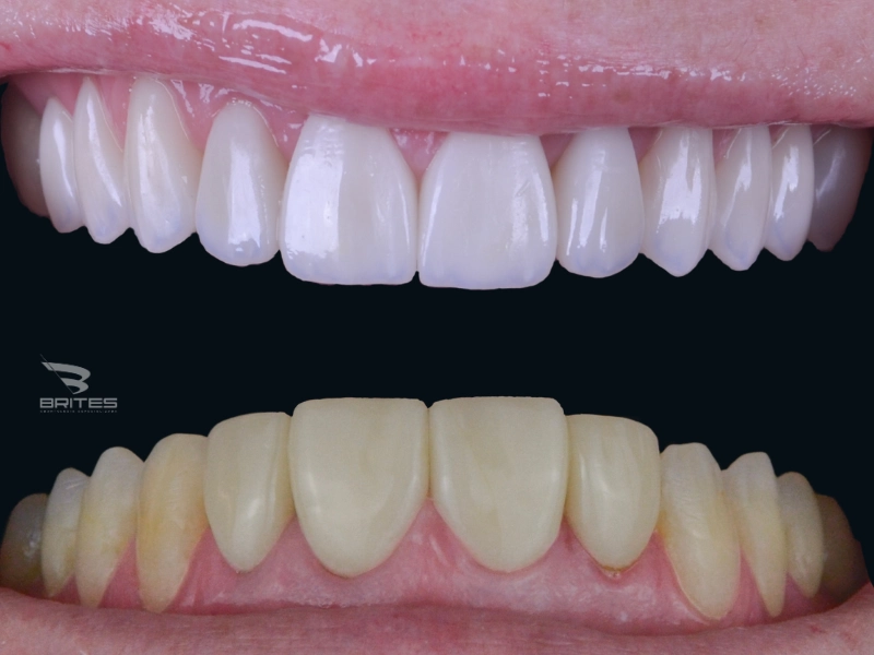 clinica brites - Simone - antes e depois