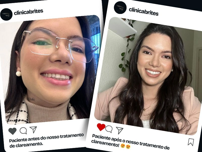 clareamento-dental-clinica-brites (2)