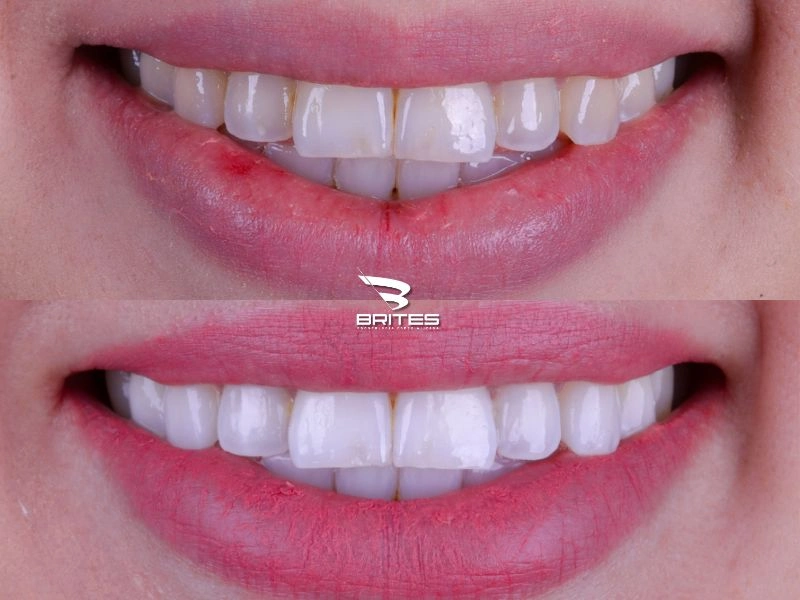 clareamento-dental-clinica-brites (3)
