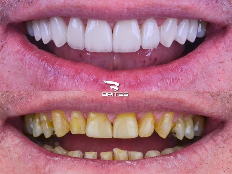 laminados_ceramicos_clinica_brites (3)