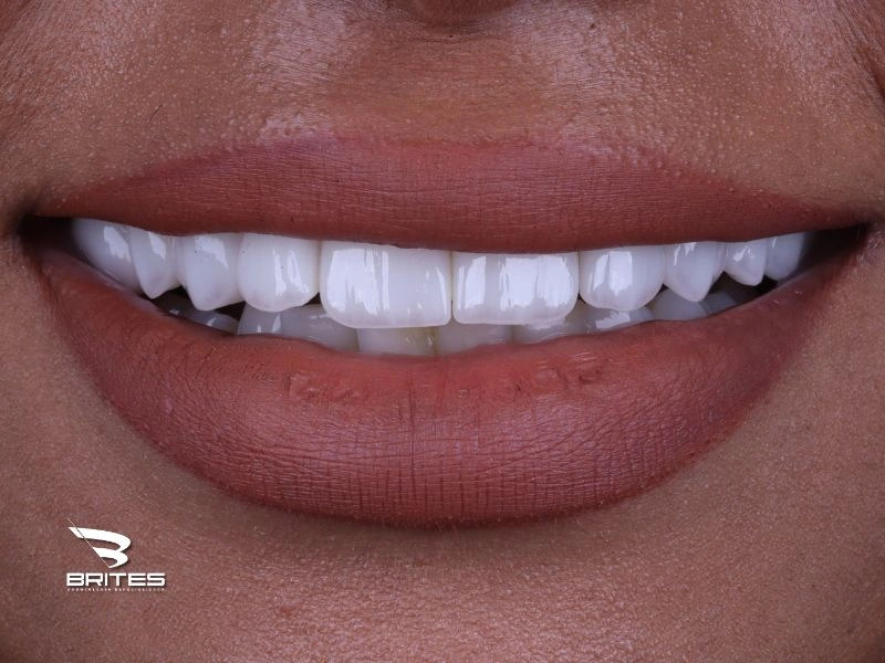 laminados_ceramicos_clinica_brites (5)